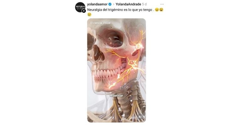 Representación gráfica de la neuralgia del trigémino afectando el rostro
